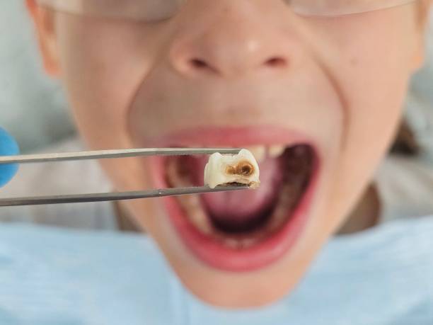 Best Emergency Broken Tooth Repair in Kensington, CA